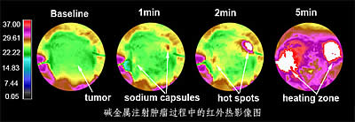 An infrared thermography image of tumor thermal ablation therapy using alkali metals
