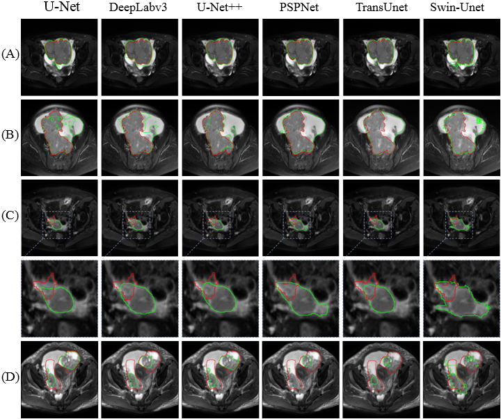 Researchers Make Automatic Tumor Segmentation on Epithelial Ovarian Cancer Images Possible with Artificial Intelligence