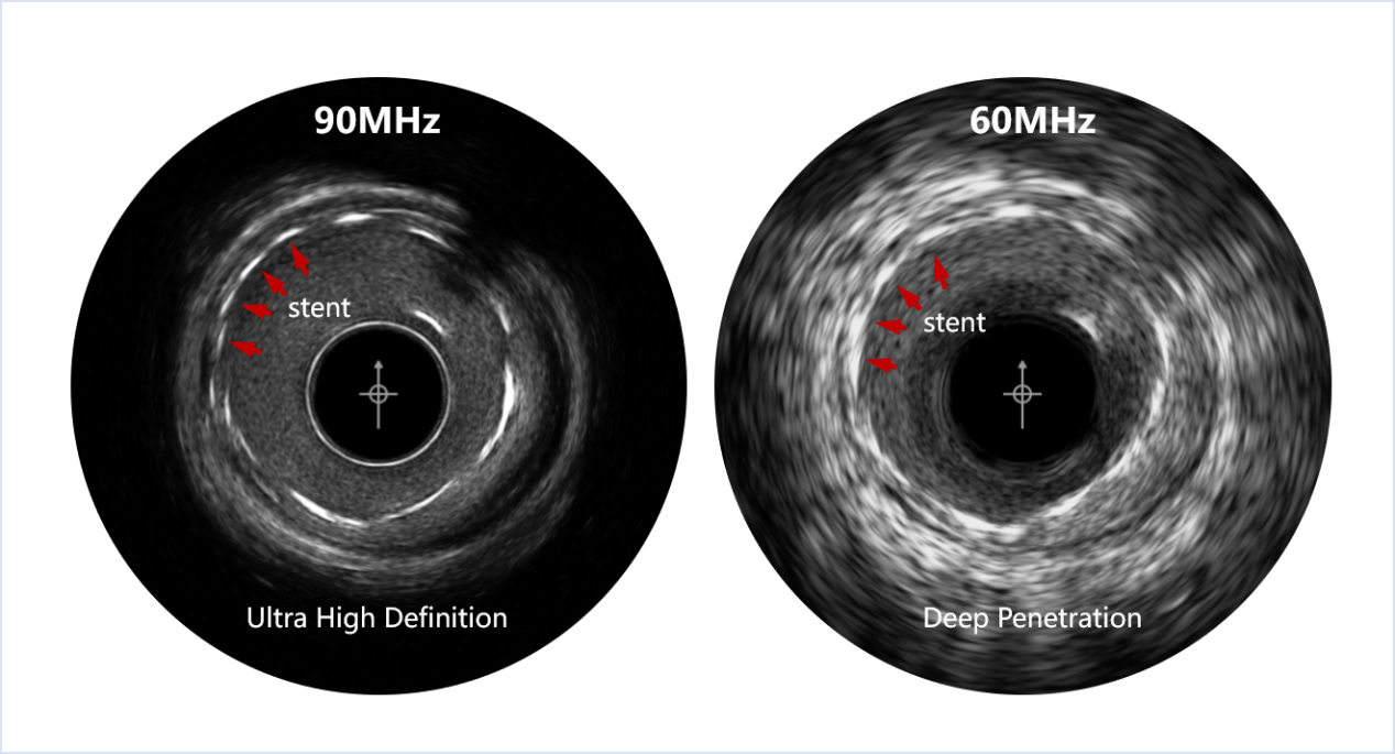 <div>From Scientific Instrument to Medical Device: SIAT's Dual-Frequency IVUS System Gains Market Approval</div>