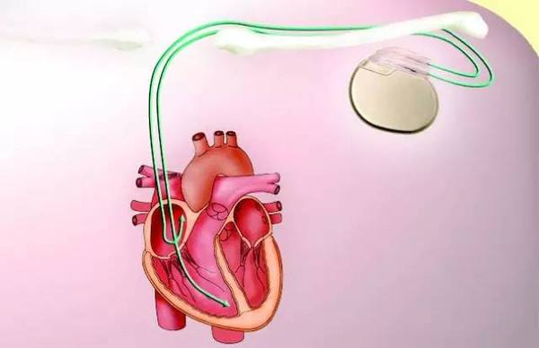 Scientists Develop Cardiac Pacemaker Powered by Heartbeat