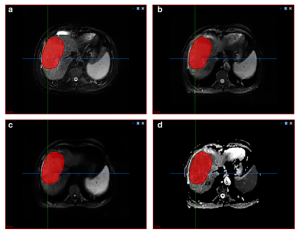 An example of the tumor VOI for different MRI sequences.png
