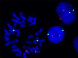 Abnormal chromosome segregation may trigger tumors