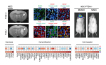 Targeted disruption of PTEN leads to neoplastic transformation of human NSCs and Mitomycin C selectively triggers apoptosis in NSCs with PTEN deficiency.jpg