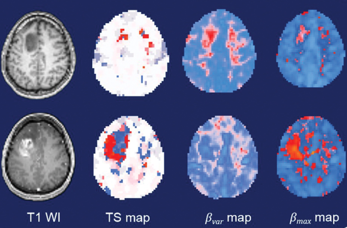 Researcher Propose New Methodology for Cerebrovascular Dysregulation in Patients with Glioma