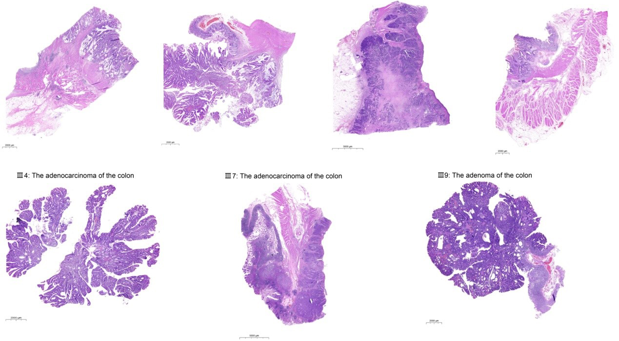 Study Reveals Somatic Mutation Profile of Colorectal Tumor with Simultaneous <EM>APC</EM> and <EM>MLH1</EM> Germline Mutations