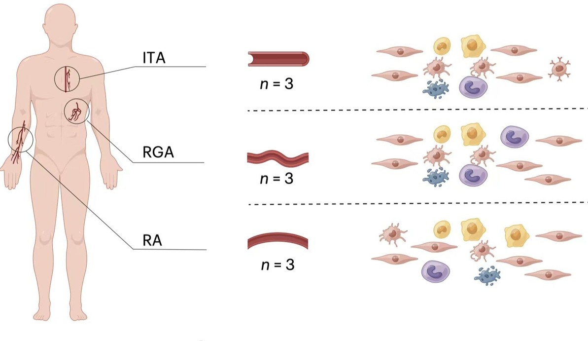 Researchers Reveal Molecular Mechanisms of Different Donor Arteries for Coronary Artery Bypass Grafting