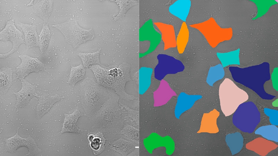 Deep Leaning Technology Shows Great Potentials in Photodynamic Therapy