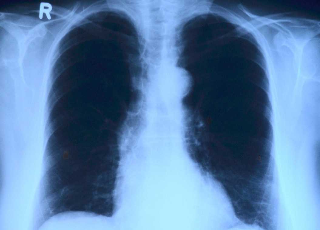 Study Reveals How Lung Tumors Hijack Ancient Marine Metabolic Axis to Promote Malignant Growth