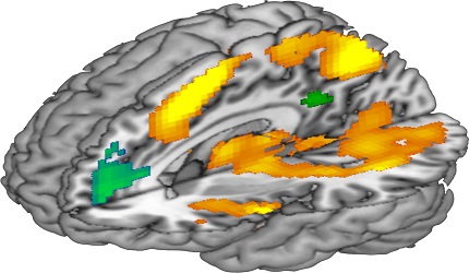 Researchers Reveal Neural Markers of Sequential Working Memory Deficits in <EM>De Novo</EM> Parkinson's Disease