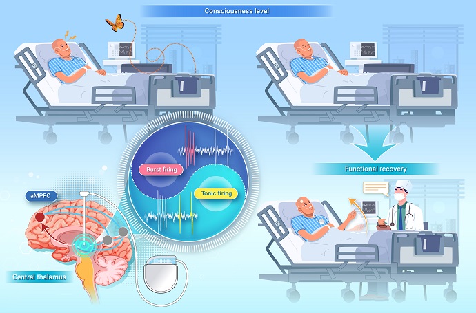 Study Reveals Neural Mechanism of Dual-mode Firing of Human Thalamic Neurons in Disorders of Consciousness